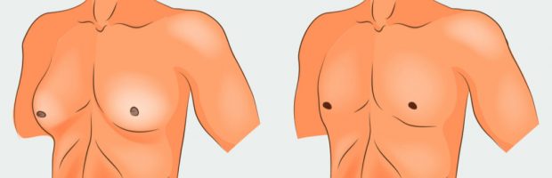 Les différentes causes qui déclenchent la gynécomastie