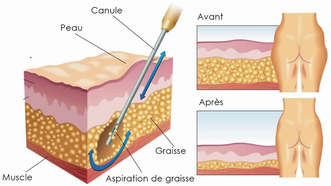 Déroulement d'une intervention de liposuccion