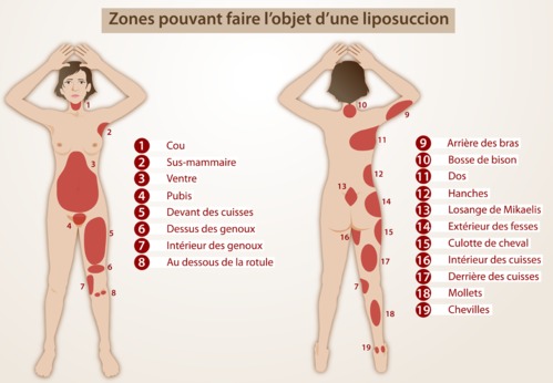 Liposuccion : quelles parties du corps ?